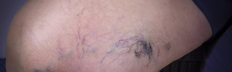 Spider Veins Memphis TN